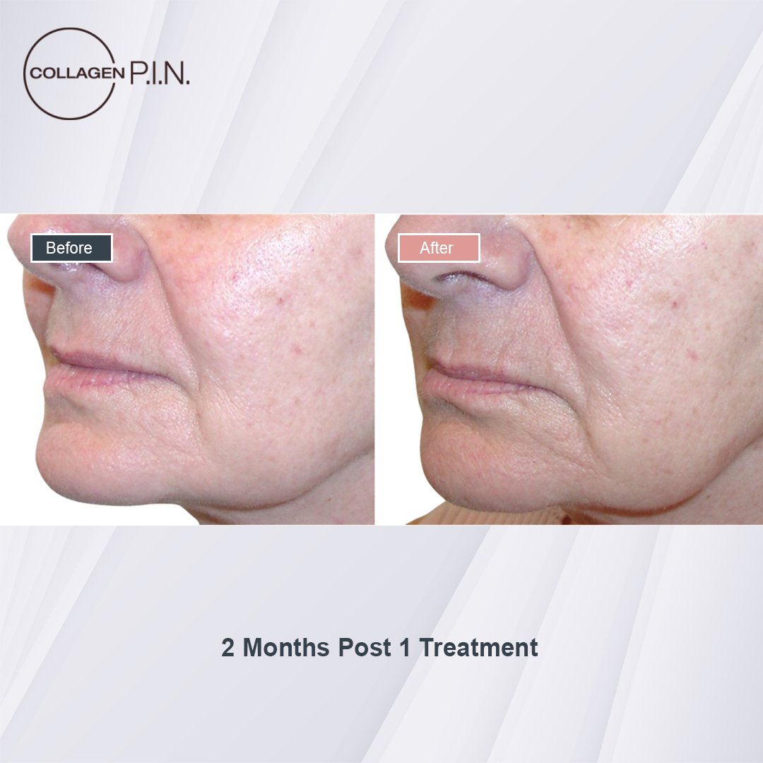 Collagen P.I.N. treatment before and after - 2