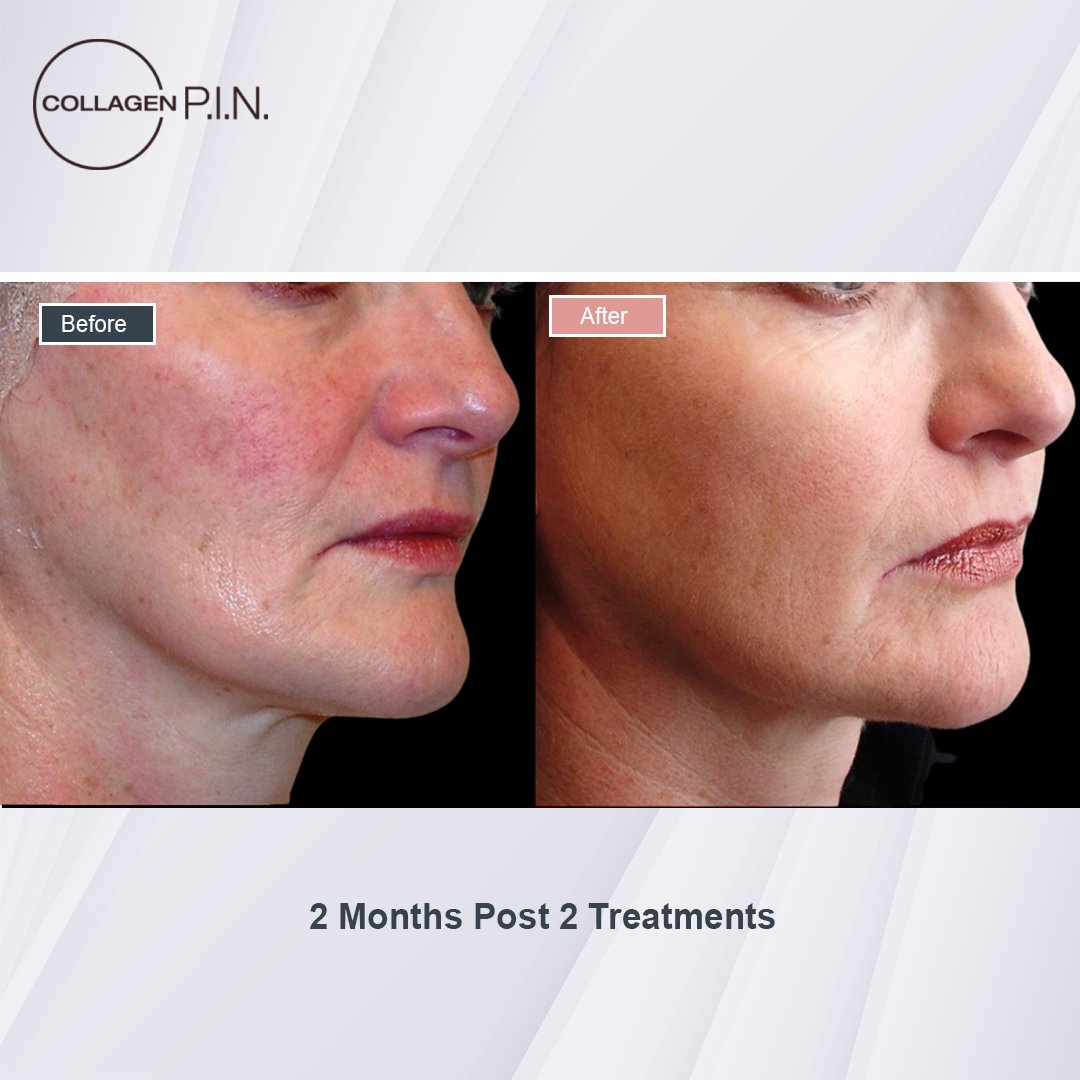 Collagen P.I.N. treatment before and after - 3