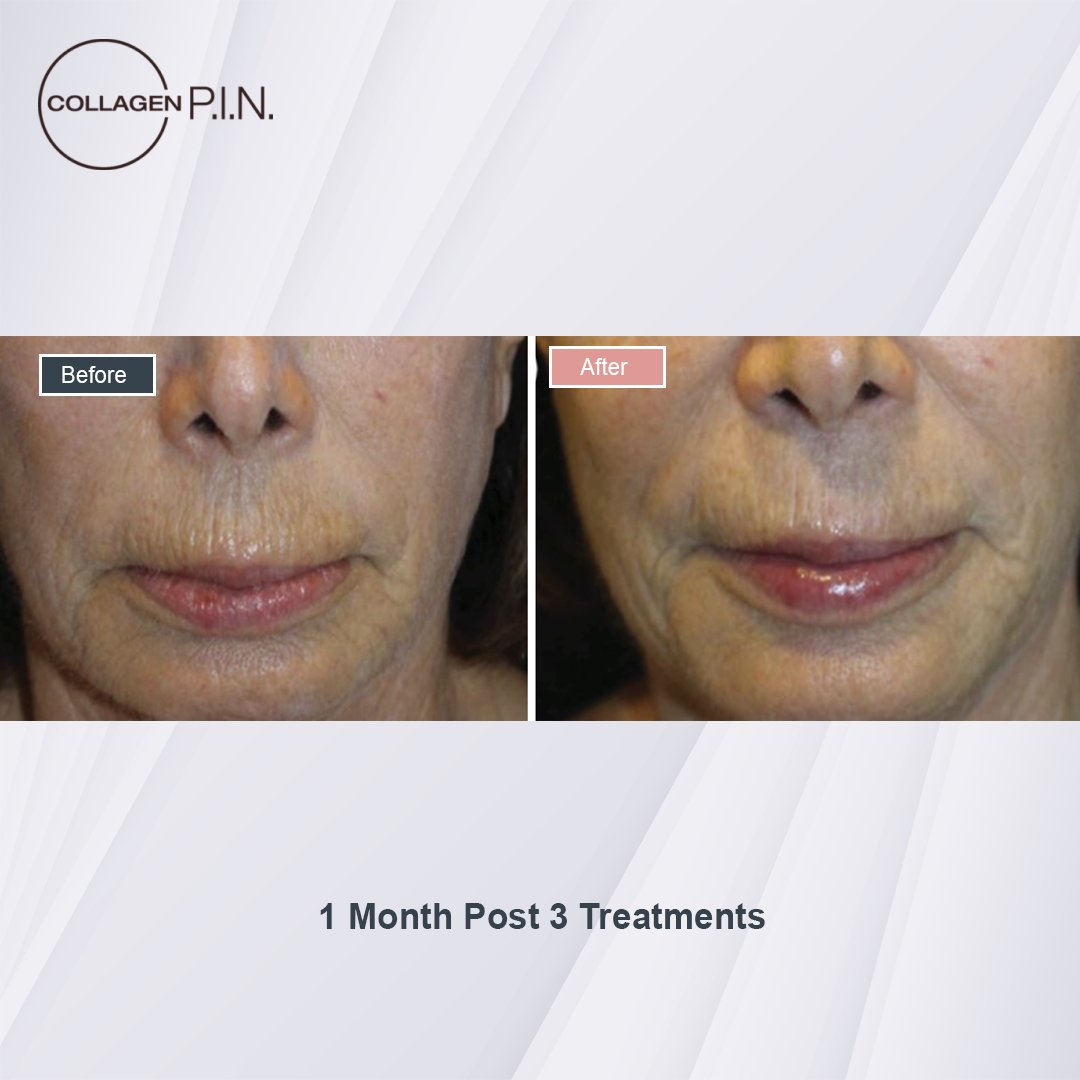 Collagen P.I.N. treatment before and after - 4