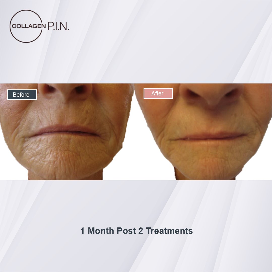 Collagen P.I.N. treatment before and after - 5