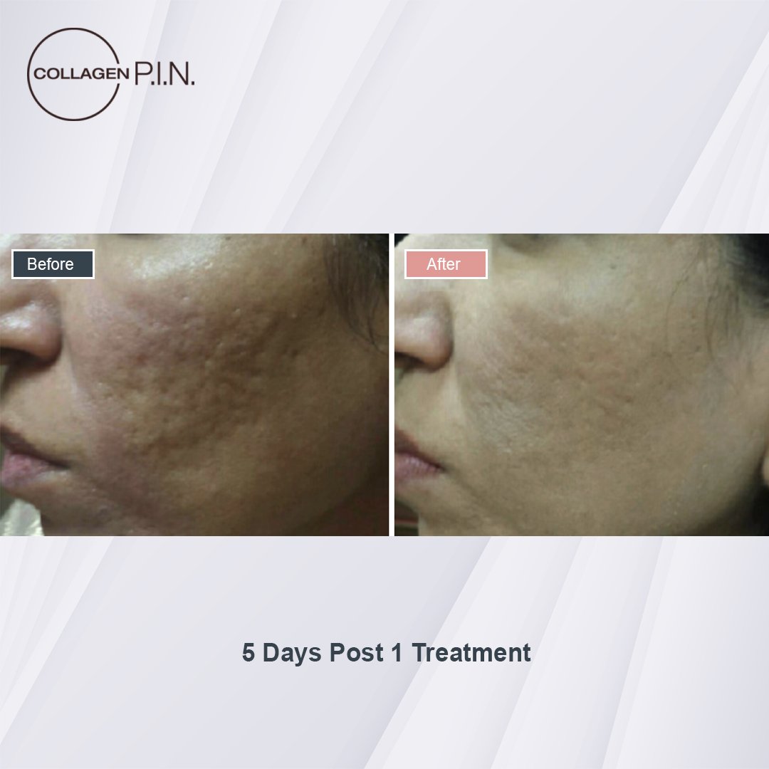 Collagen P.I.N. treatment before and after - 5