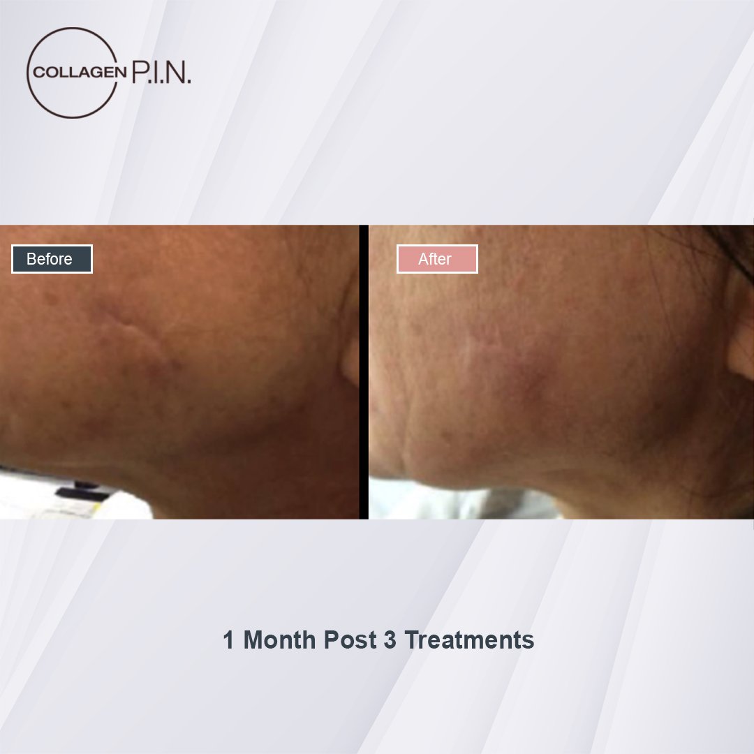 Collagen P.I.N. treatment before and after - 7