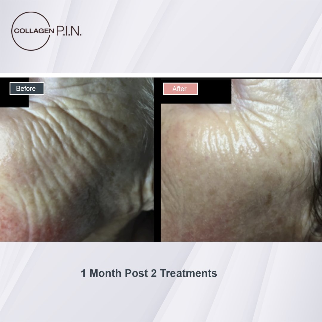 Collagen P.I.N. treatment before and after - 9