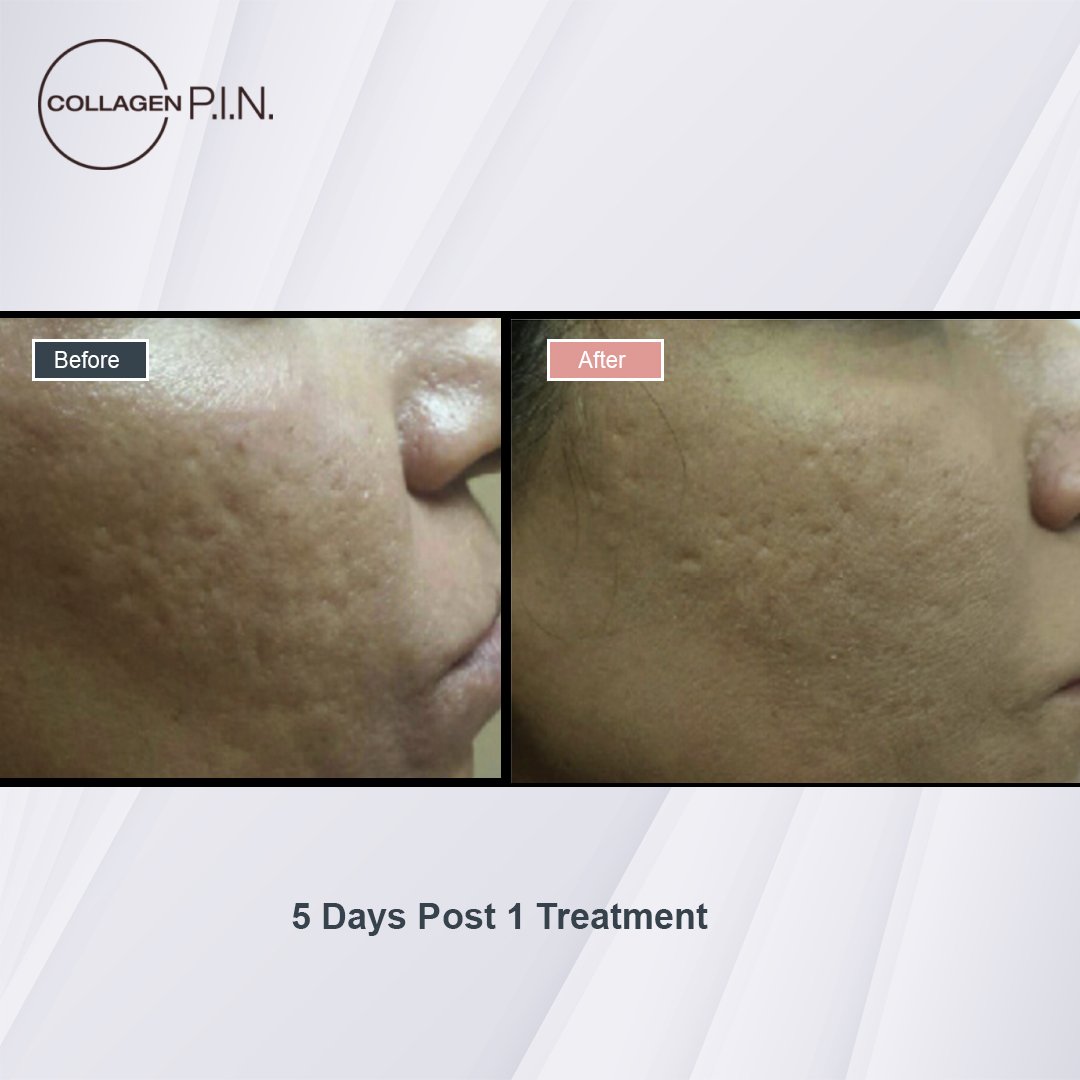 Collagen P.I.N. treatment before and after - 10