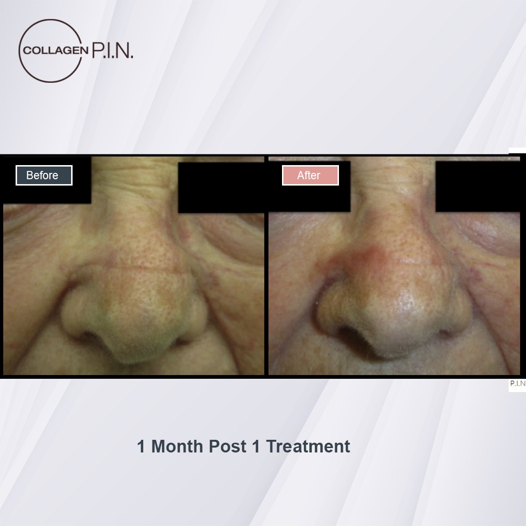 Collagen P.I.N. treatment before and after - 11