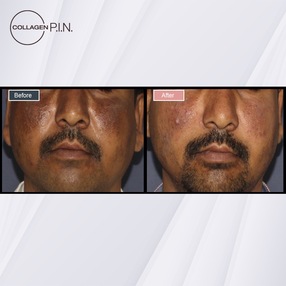 Collagen P.I.N. treatment before and after - 12