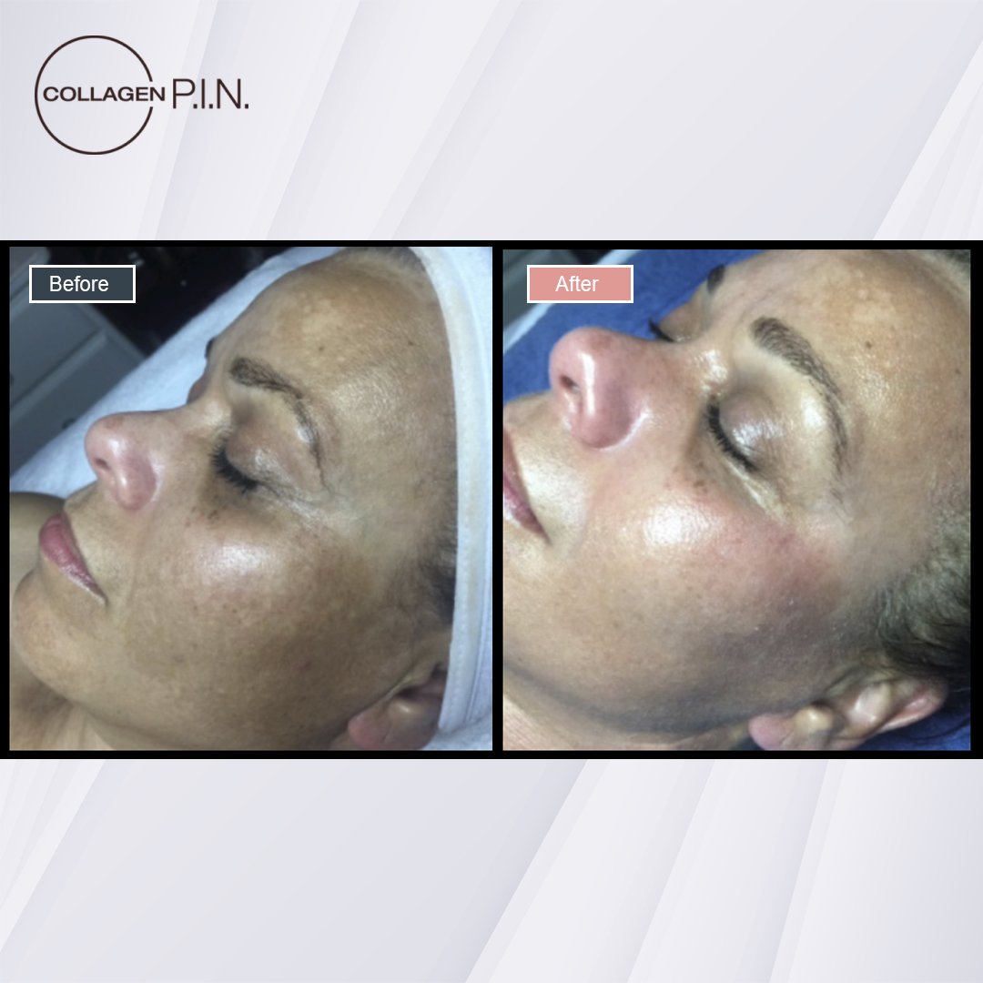 Collagen P.I.N. treatment before and after - 13