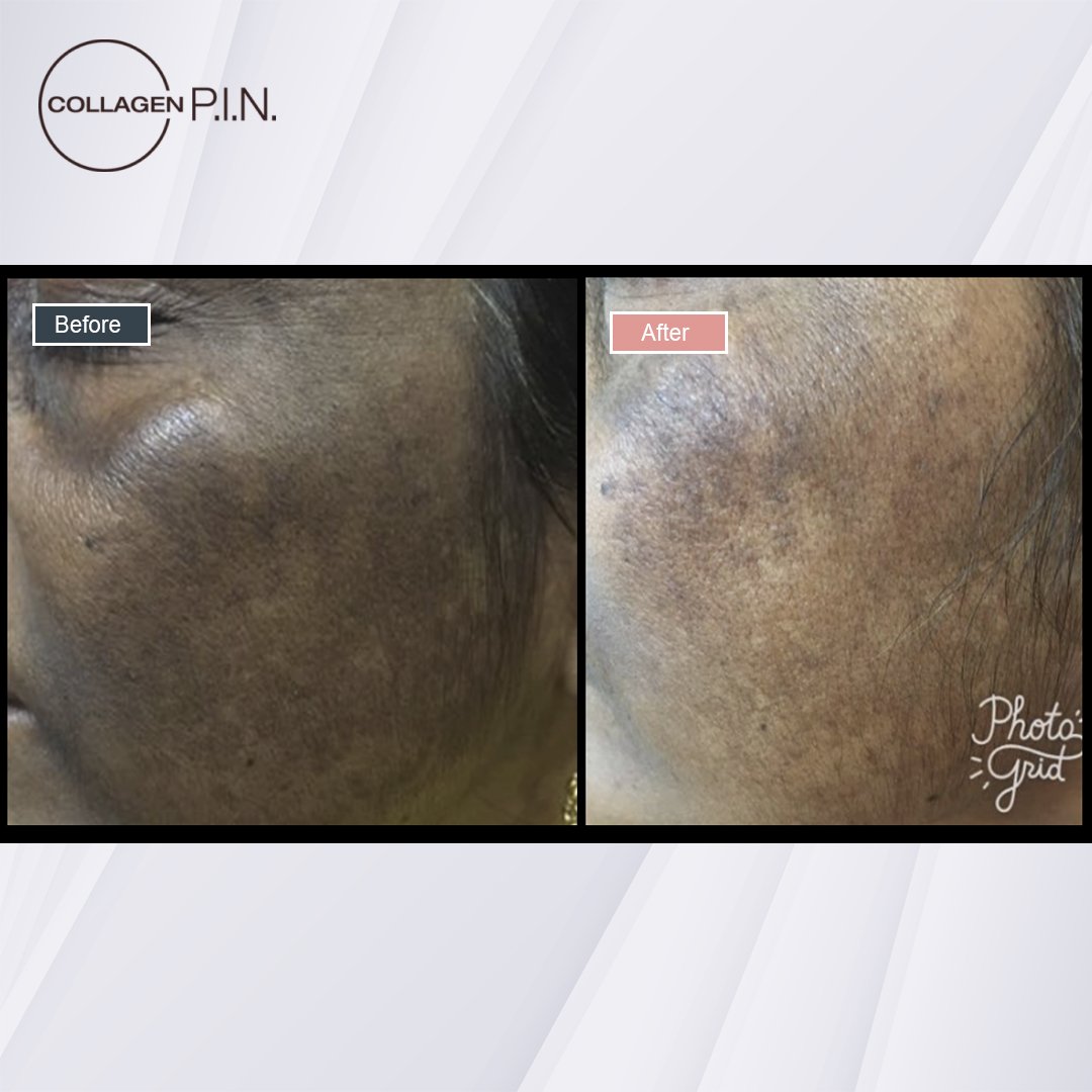 Collagen P.I.N. treatment before and after - 14