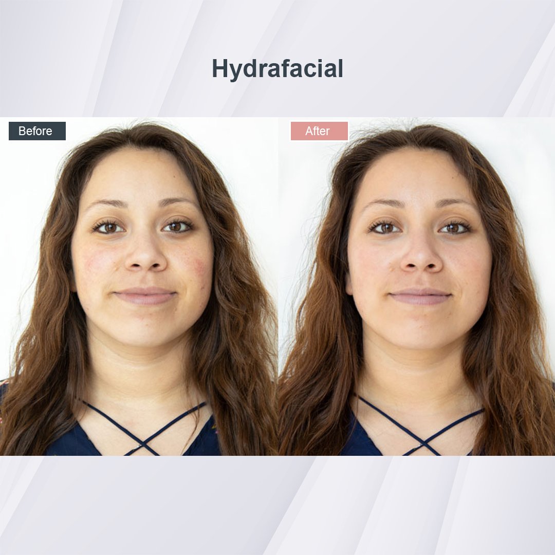 Hydrafacial treatment before and after