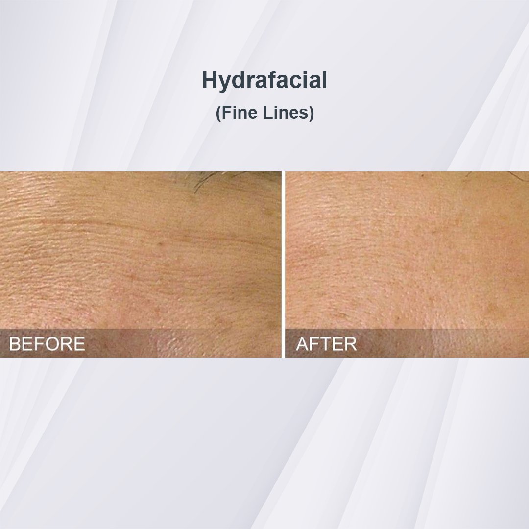 Hydrafacial treatment before and after - 2