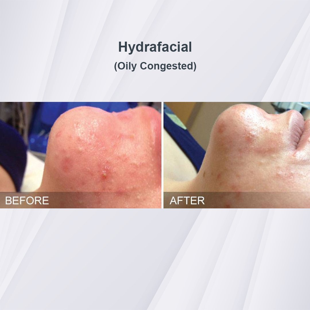 Hydrafacial treatment before and after - 3