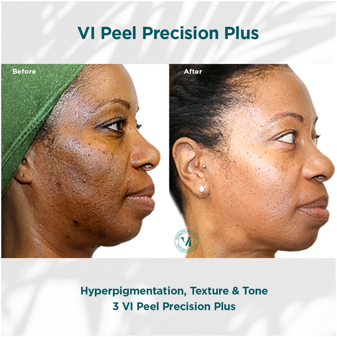 VI Peel treatment before and after