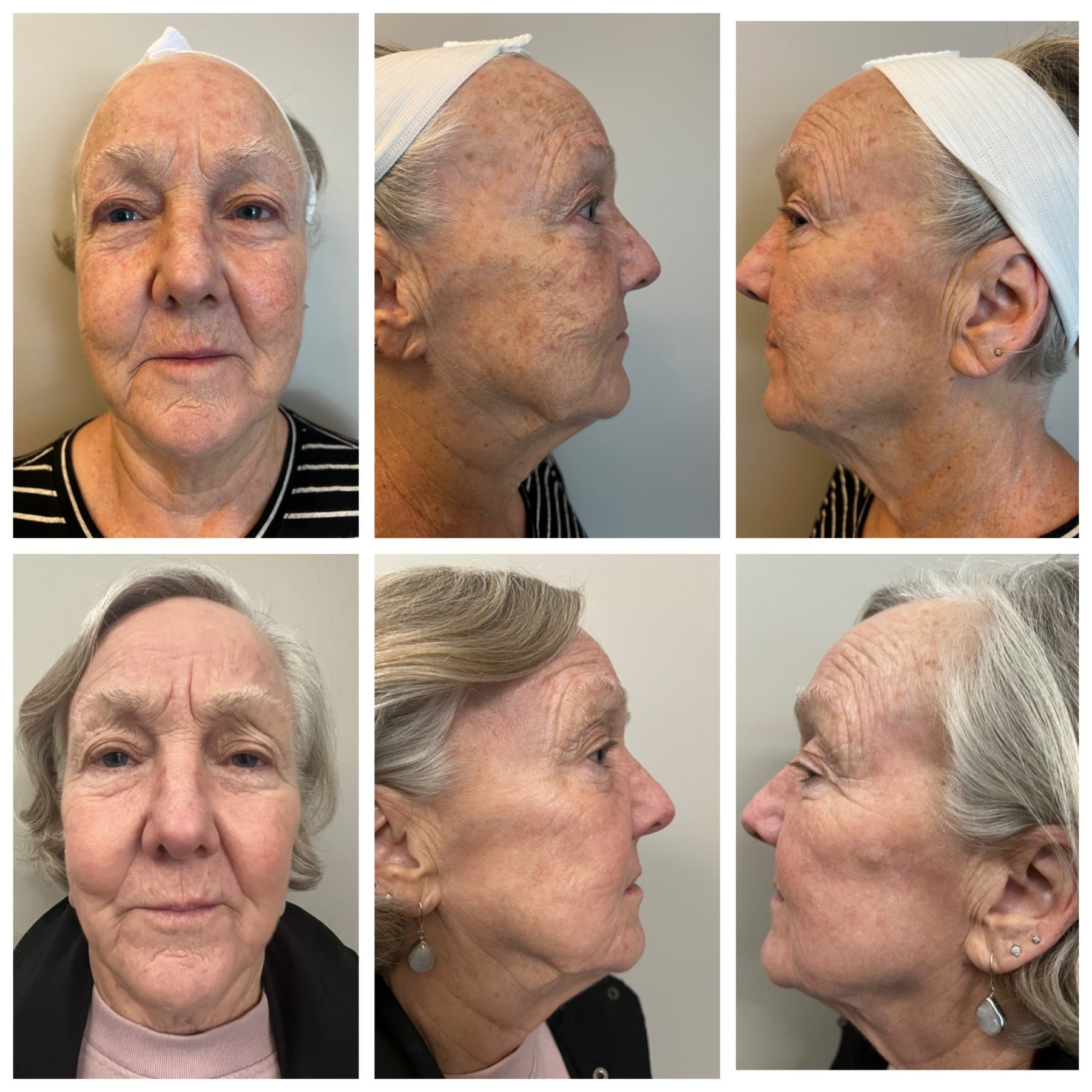 Collagen P.I.N. treatment before and after - 20