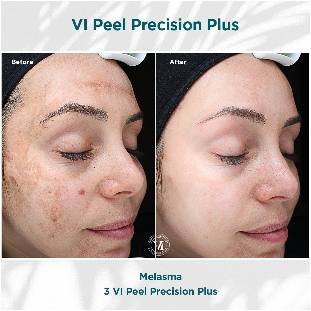 VI Peel treatment before and after - 14