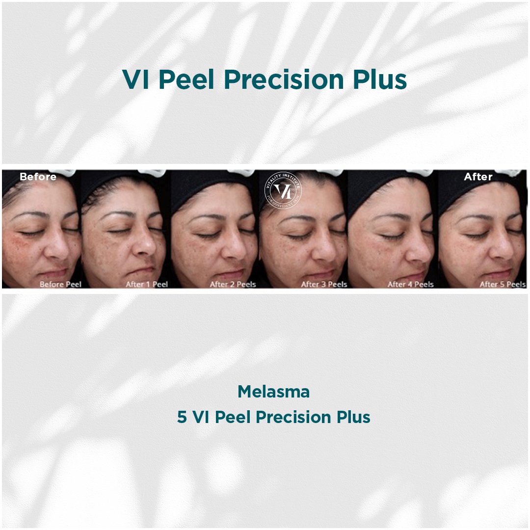 VI Peel treatment before and after - 15
