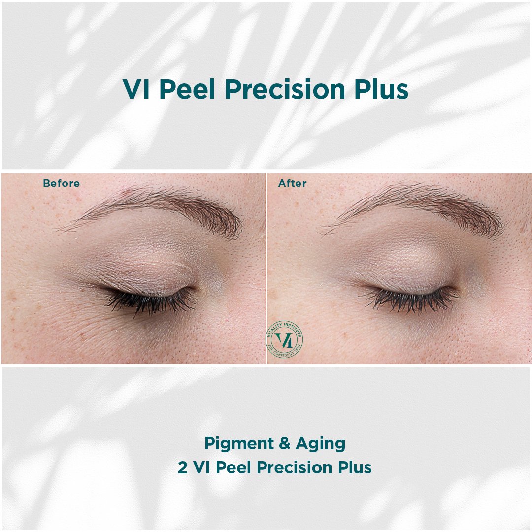 VI Peel treatment before and after - 13