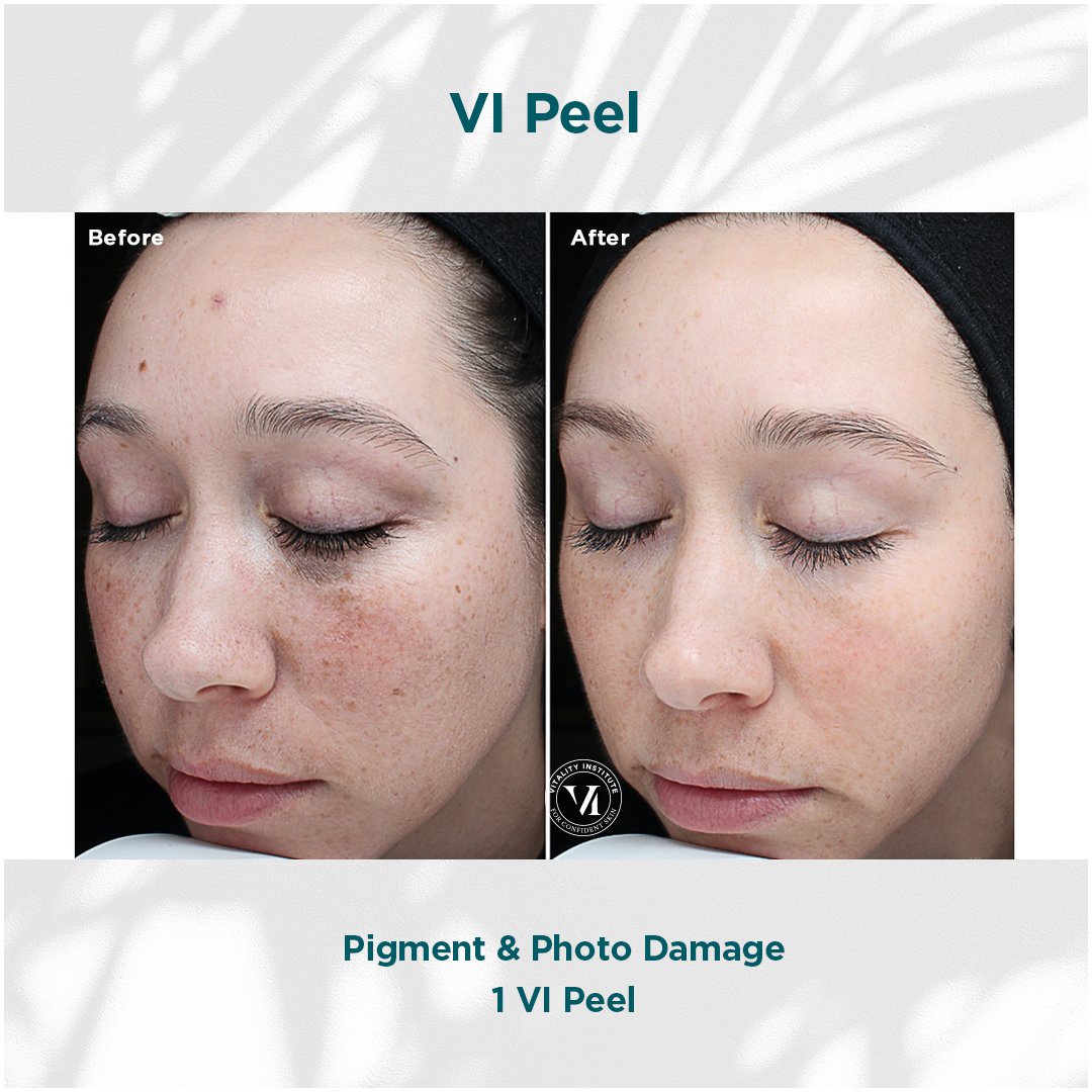 VI Peel treatment before and after - 17