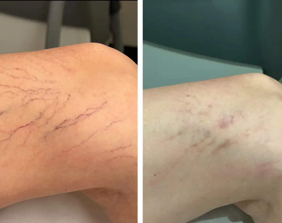 What Is The Recovery Time for Spider Vein Treatment?, Albuquerque Spider  Veins