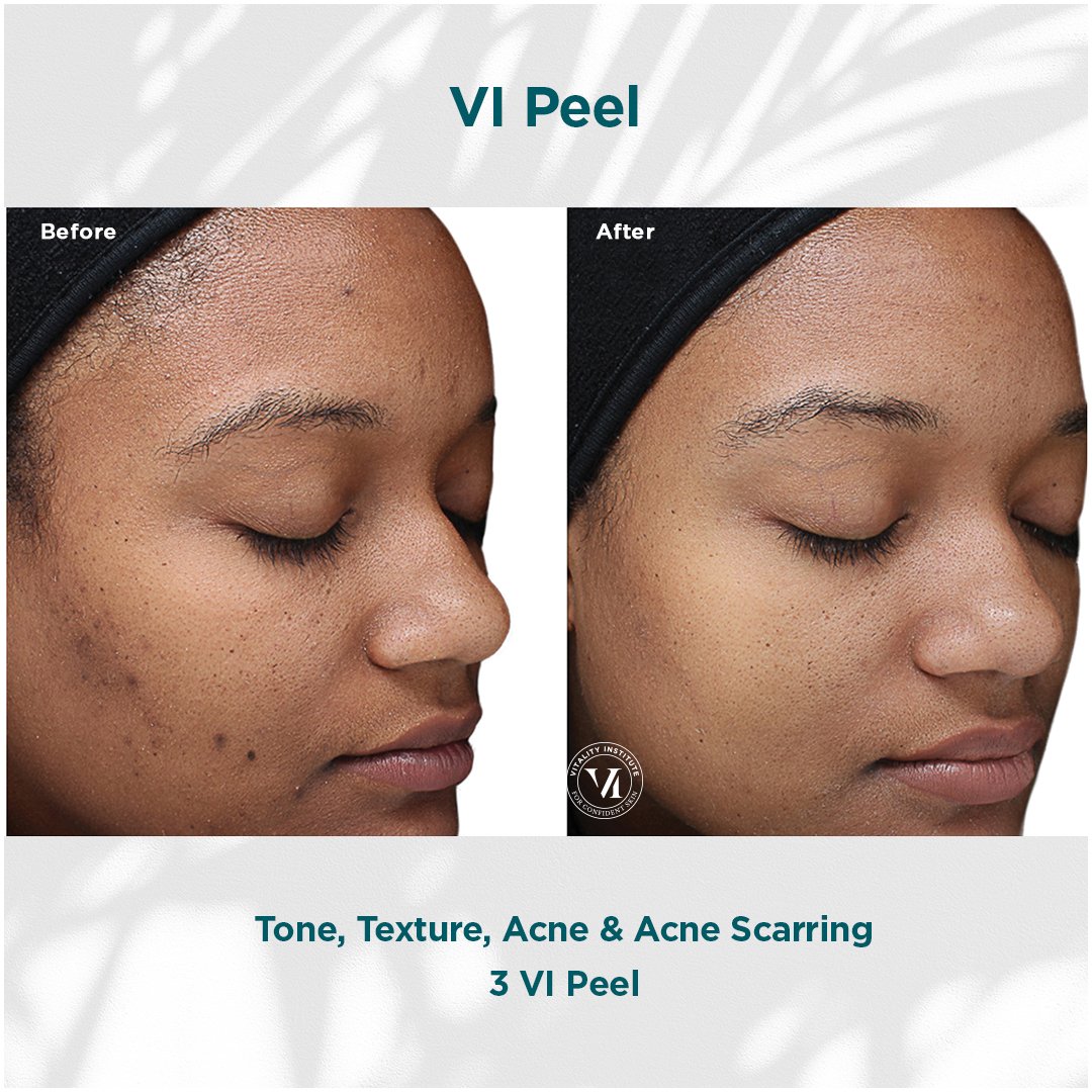 VI Peel treatment before and after - 16