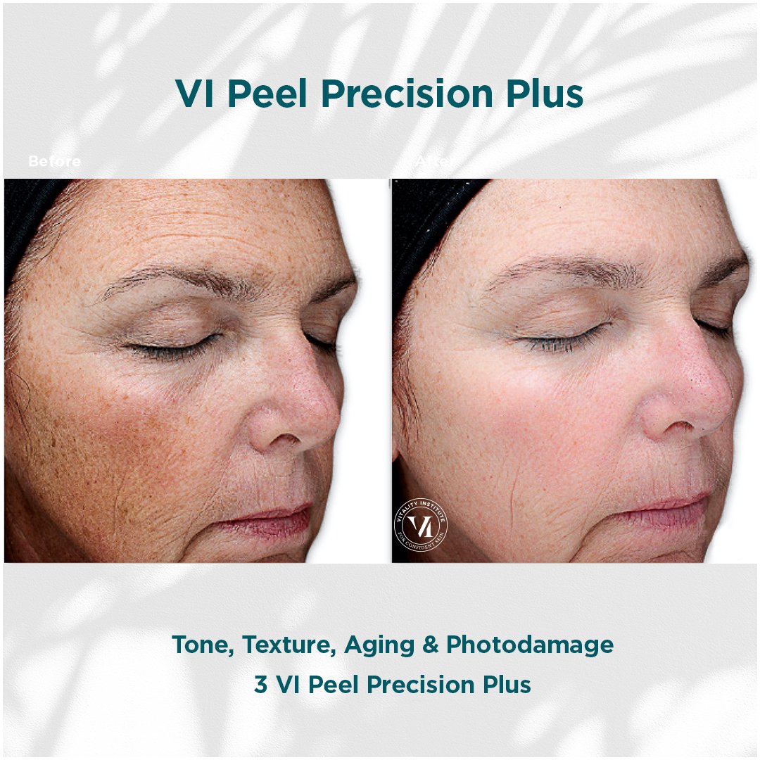 VI Peel treatment before and after - 11