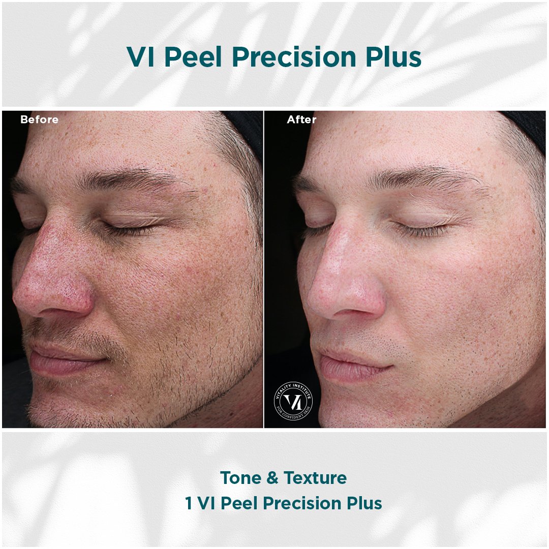 VI Peel treatment before and after - 12