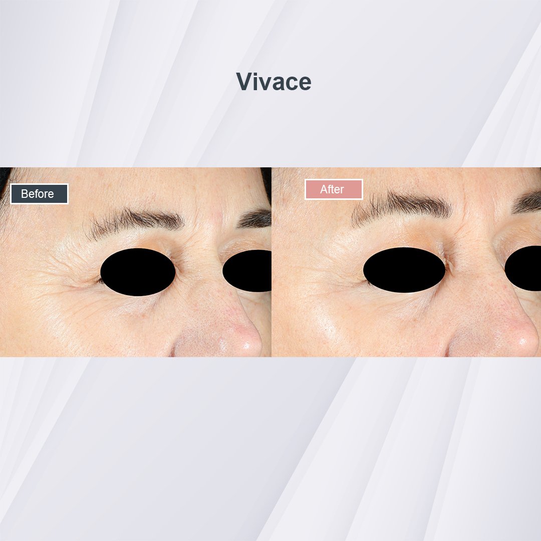 Vivace treatment before and after