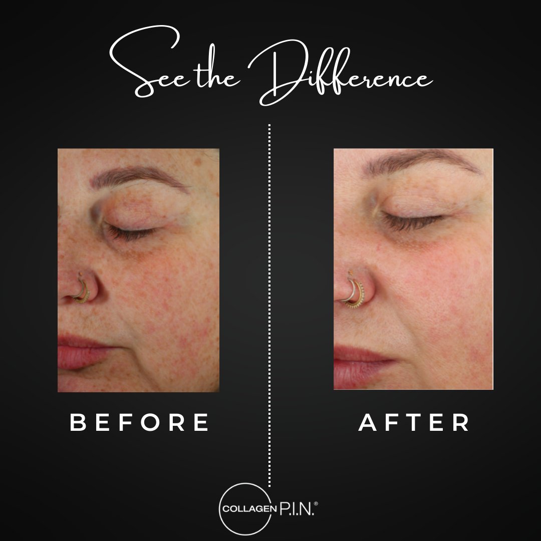 Collagen P.I.N. treatment before and after - 19