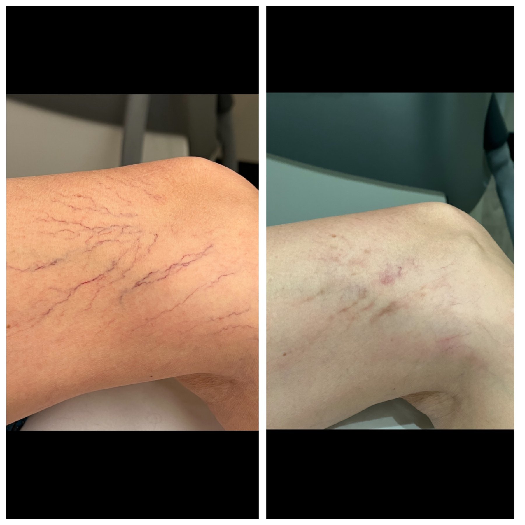 Collagen P.I.N. treatment before and after - 15