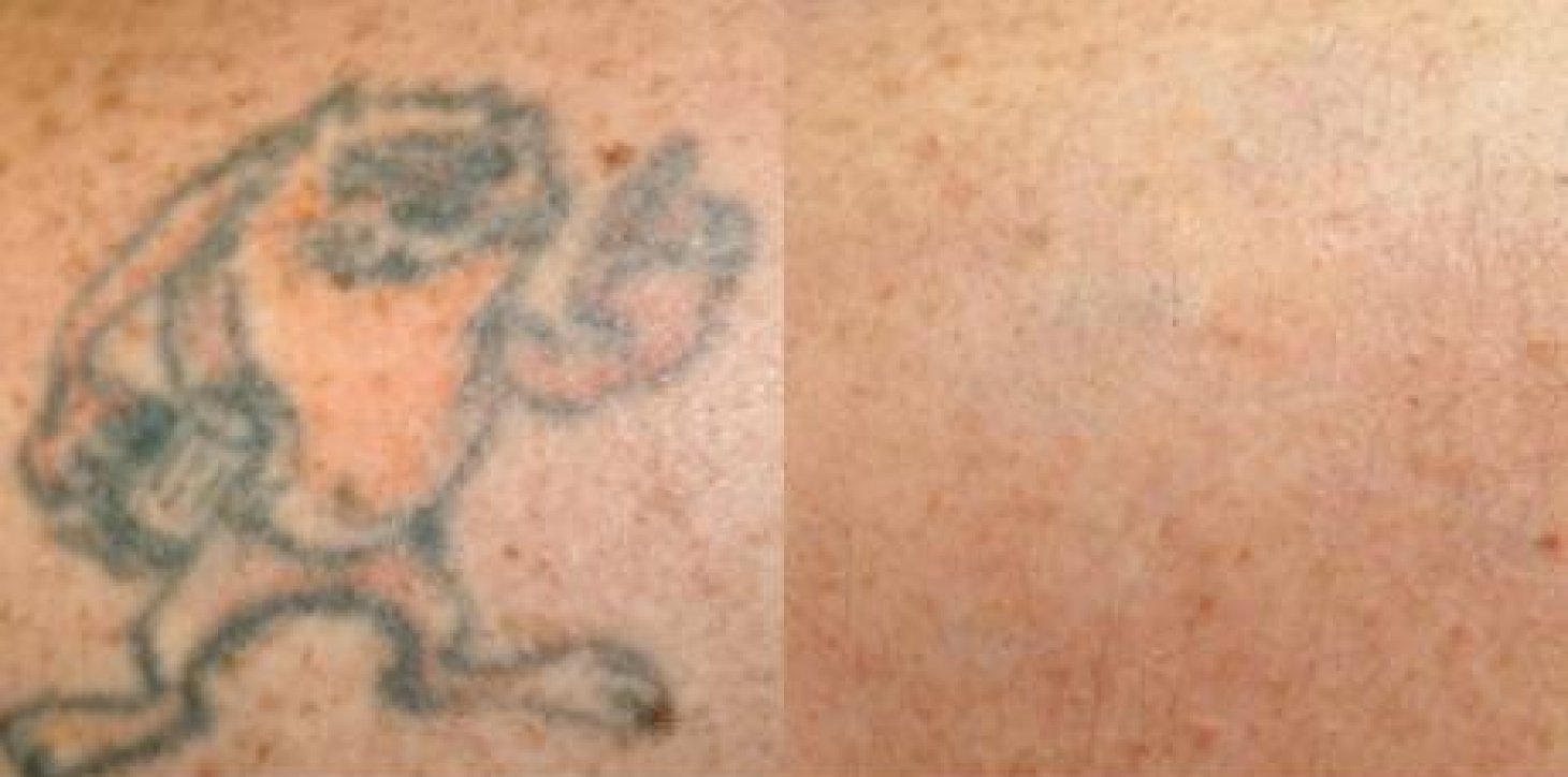 DIEP treatment before and after - 6