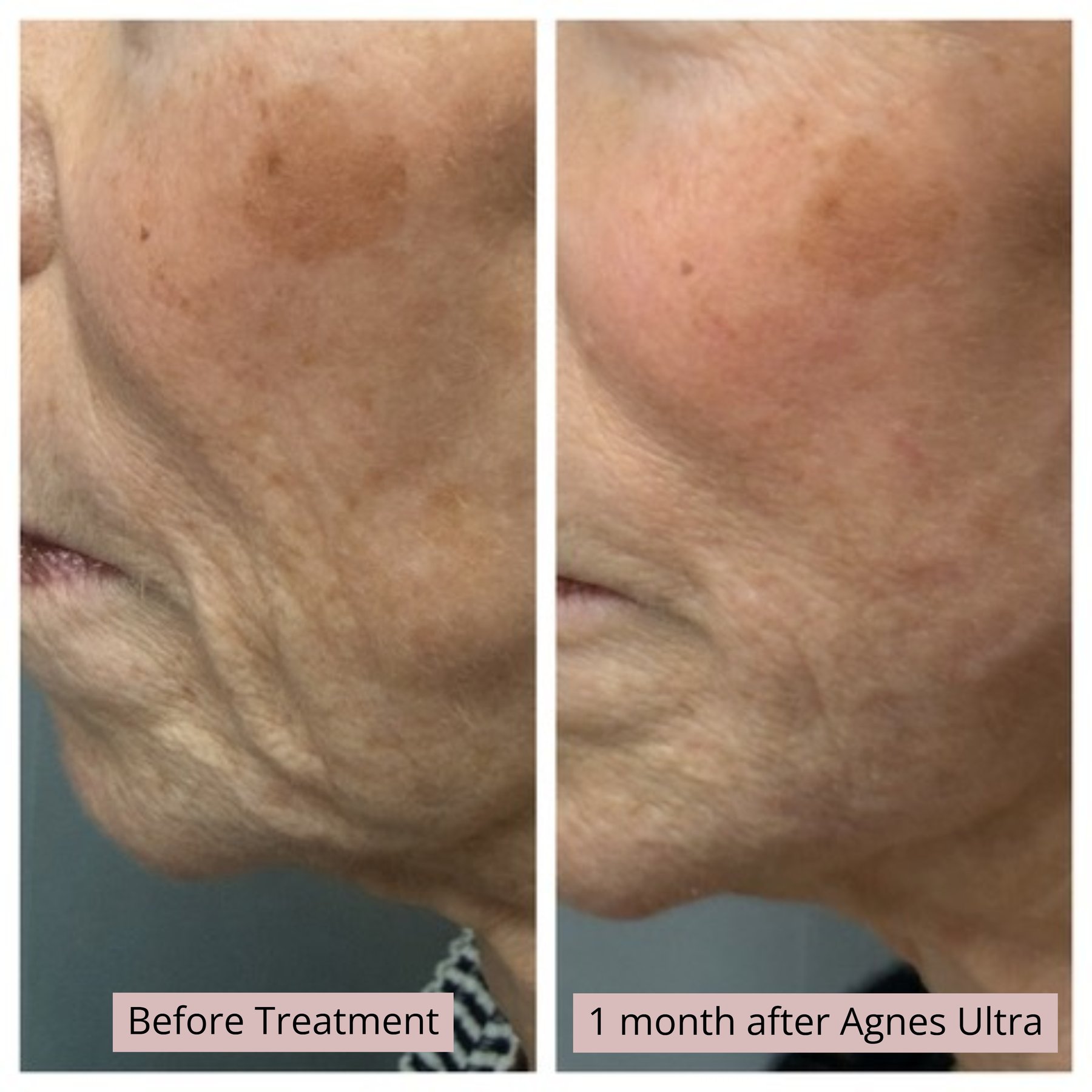 Agnes Ultra 1