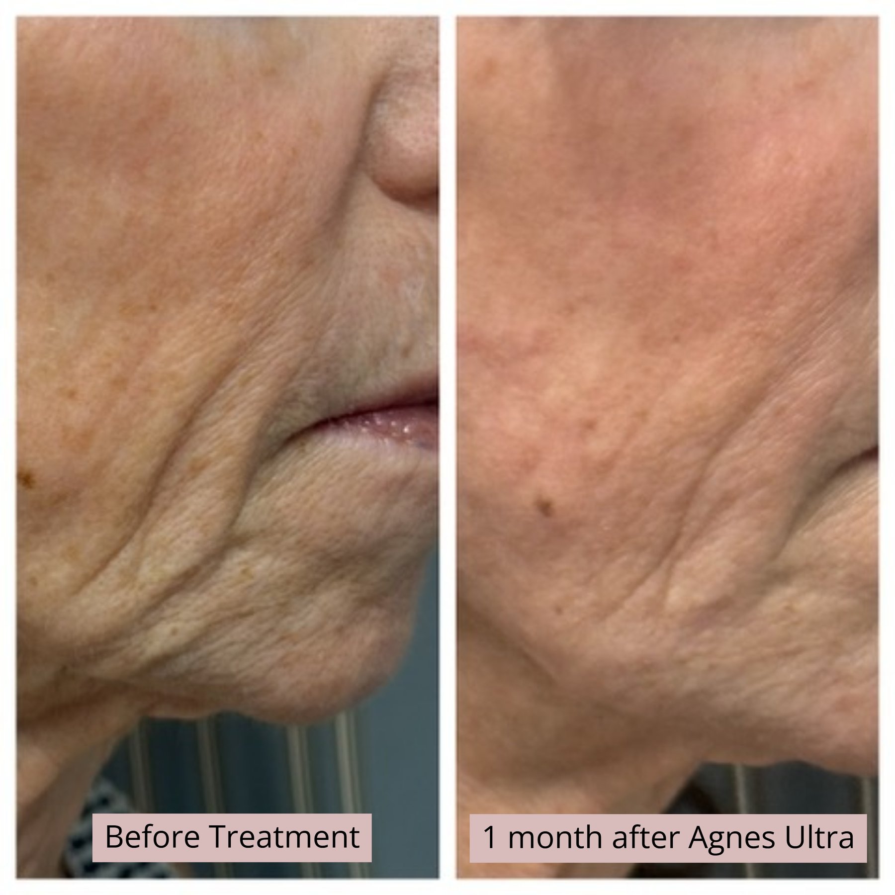 Agnes Ultra 2