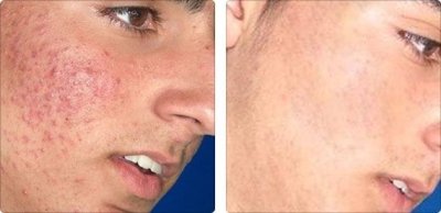 Acne Treatments Before and After