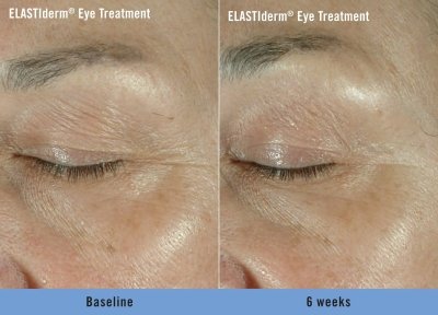 ELASTIderm Eye Treatment Before and After 2