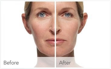 Juvederm Filler Before and After 2
