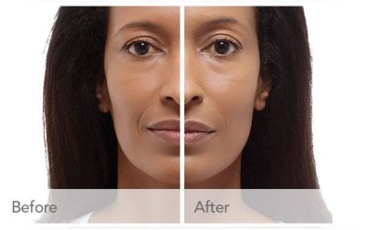 Juvederm Filler Before and After 3