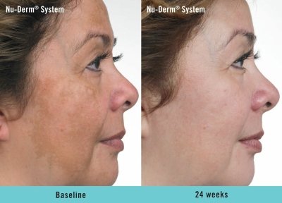 Nu Derm System Before and After 2