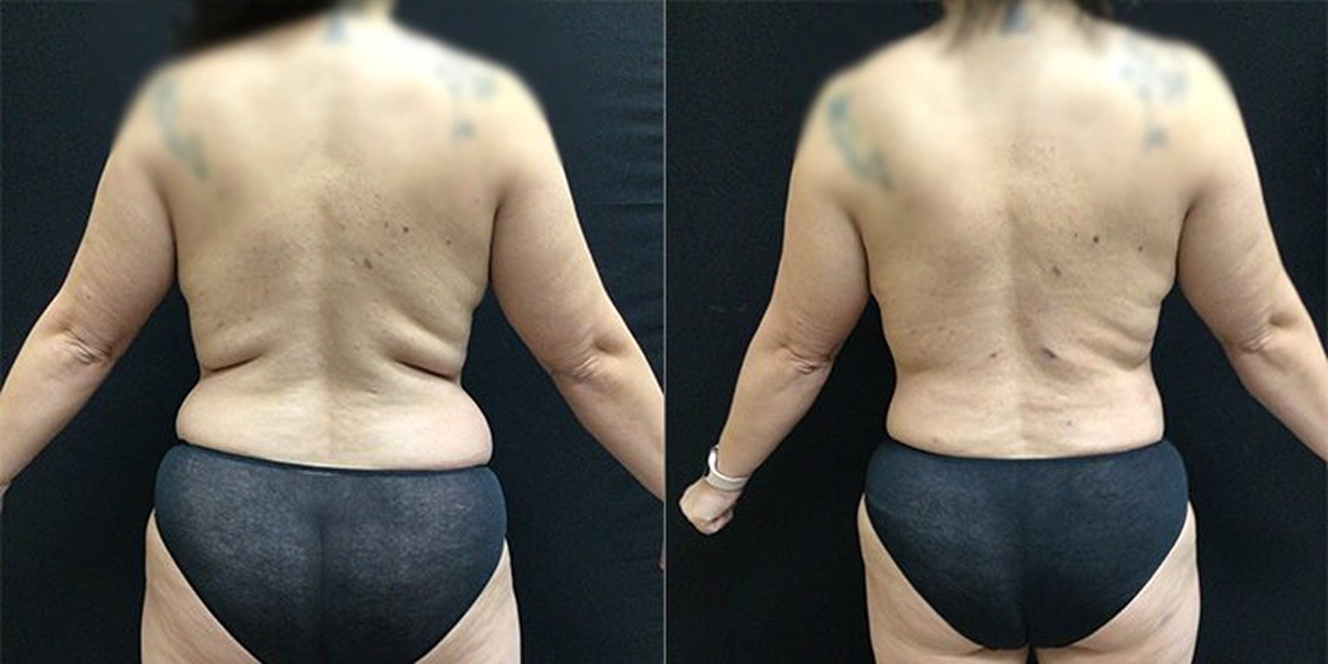 Liposuction Patient 4 - Back View