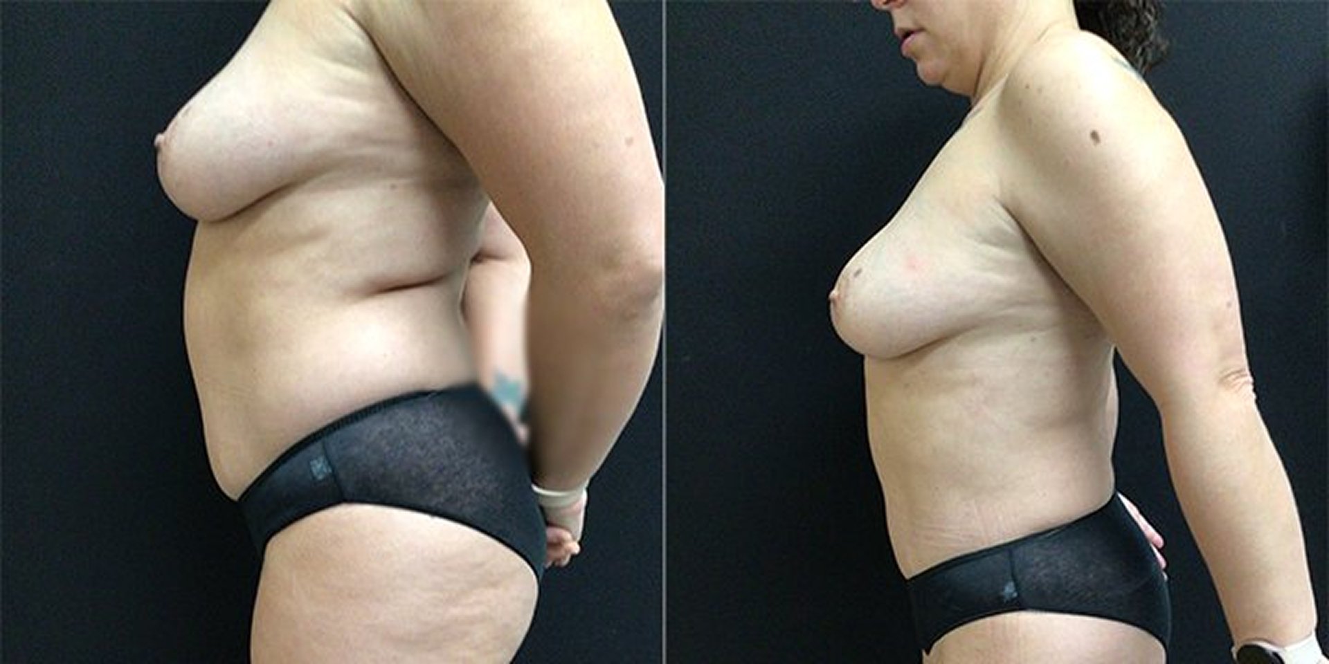 Liposuction Patient 3 - Left view