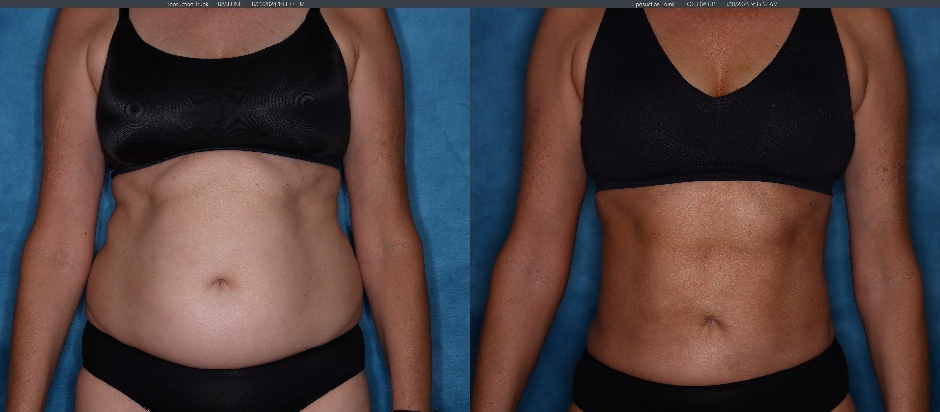 Liposuction Patient 2 - Front View