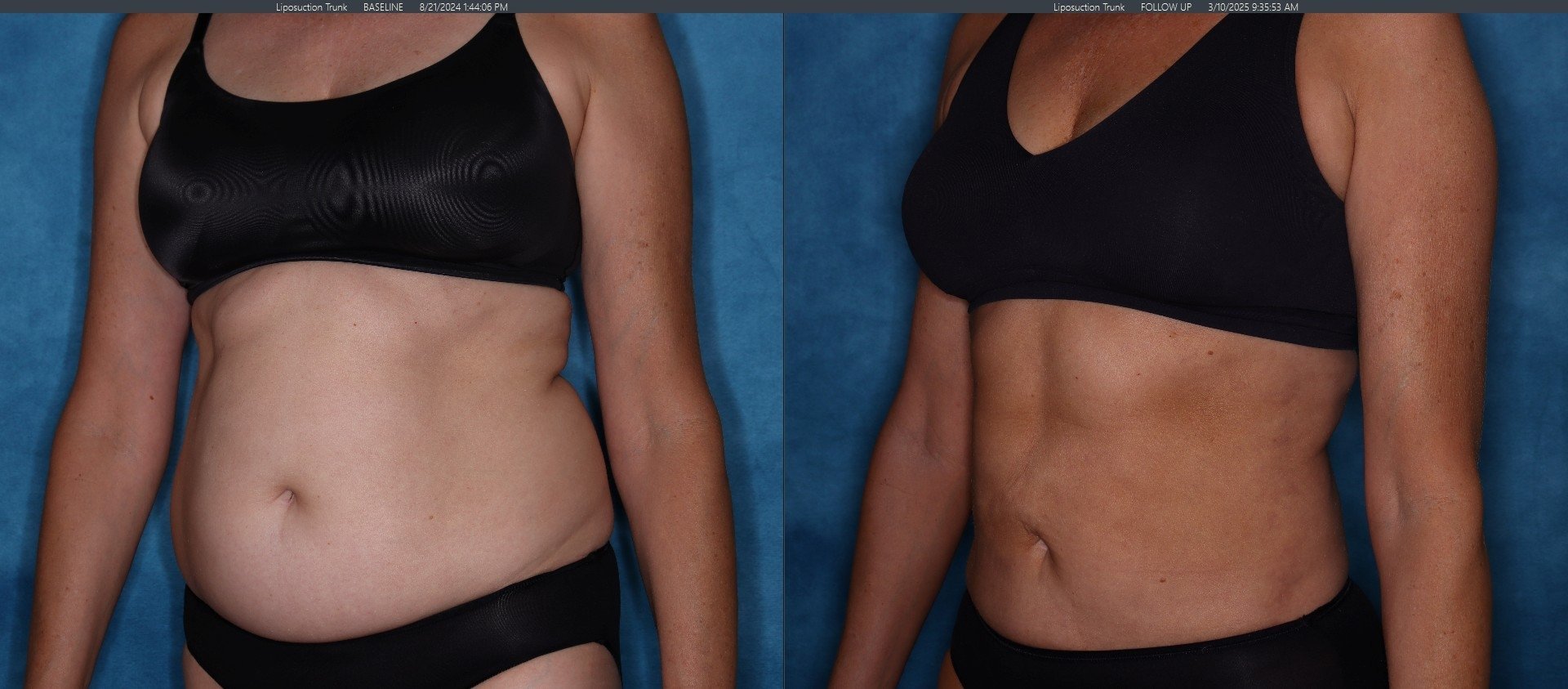 Liposuction Patient 2 - Left Diagonal