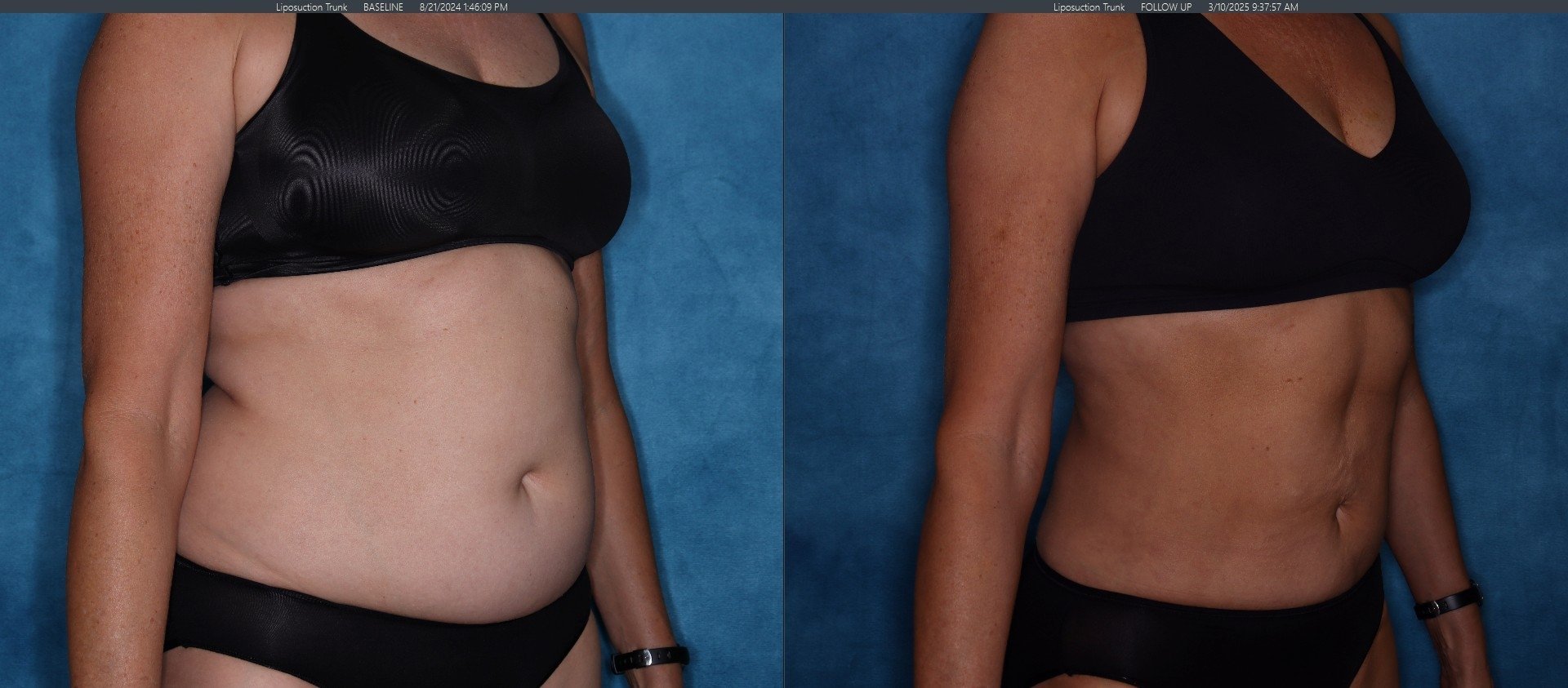Liposuction Patient 3 - Right Diagonal