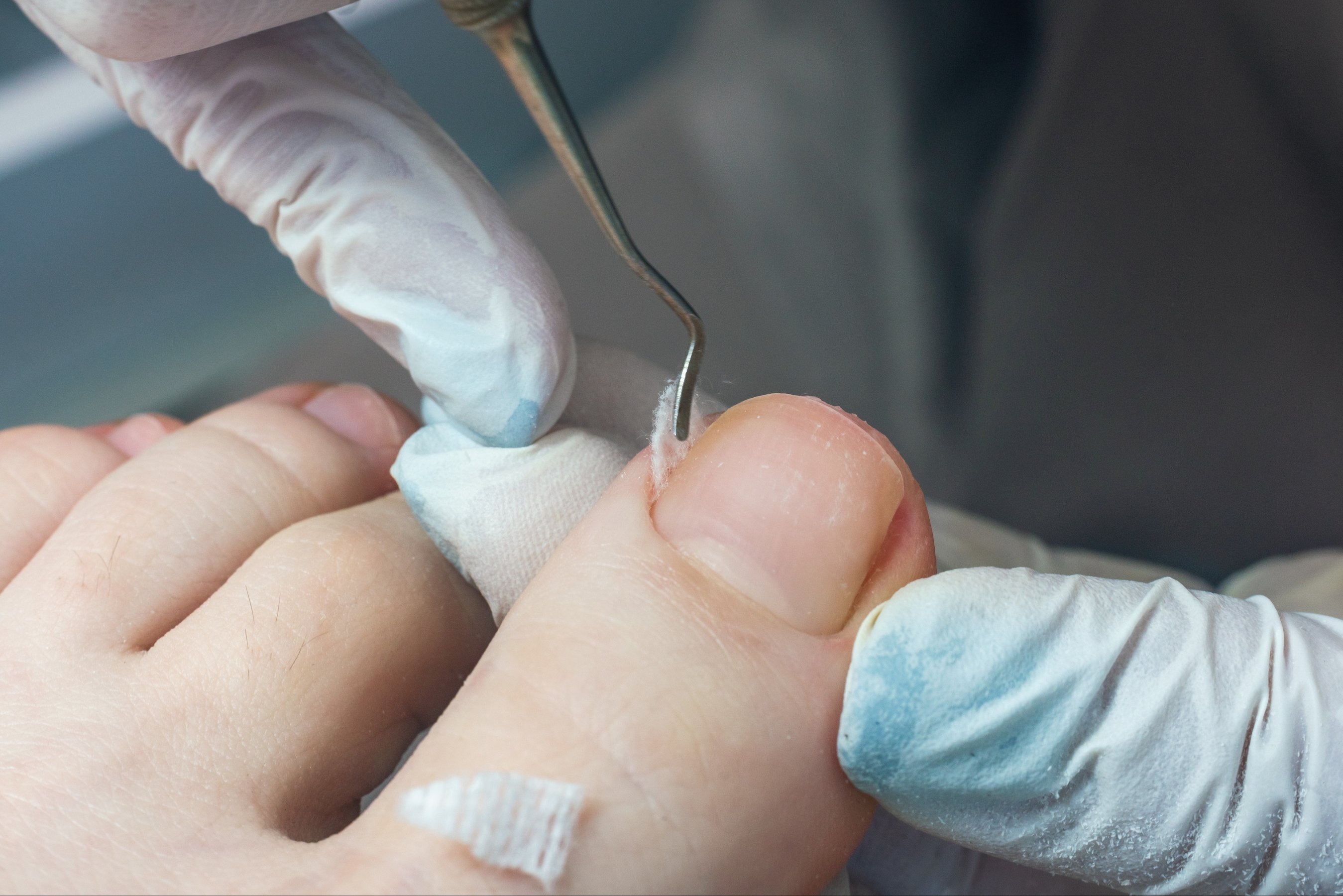 podiatrist doing tamponade to a deformed toenail