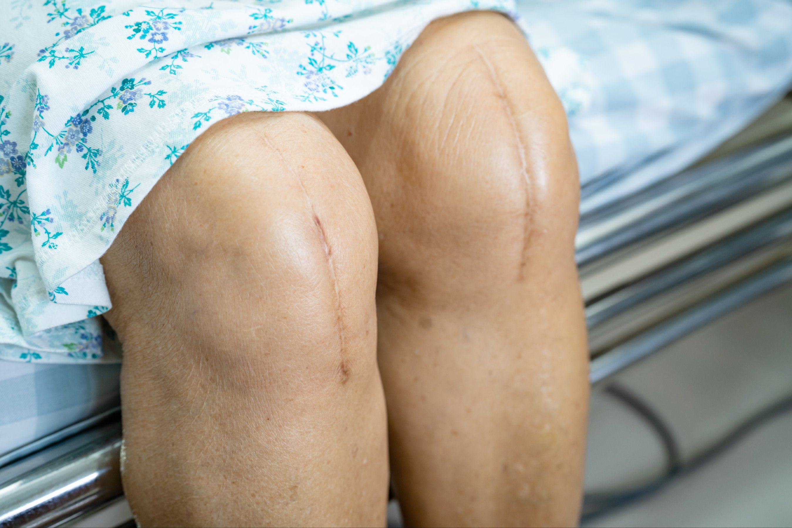 elderly old lady woman patient show her scars surgical total knee joint replacement