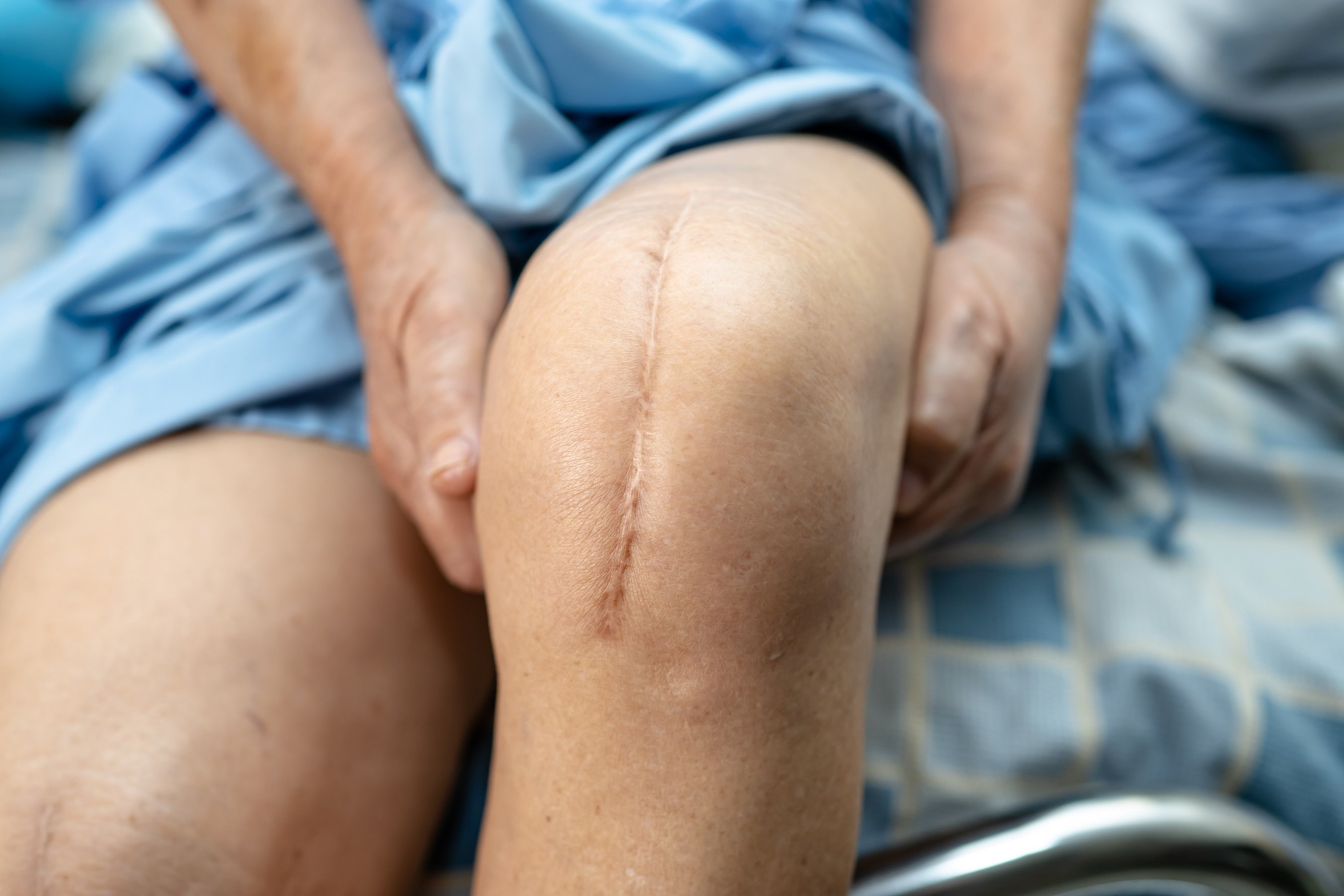 woman patient show her scars surgical total knee joint replacement Suture
