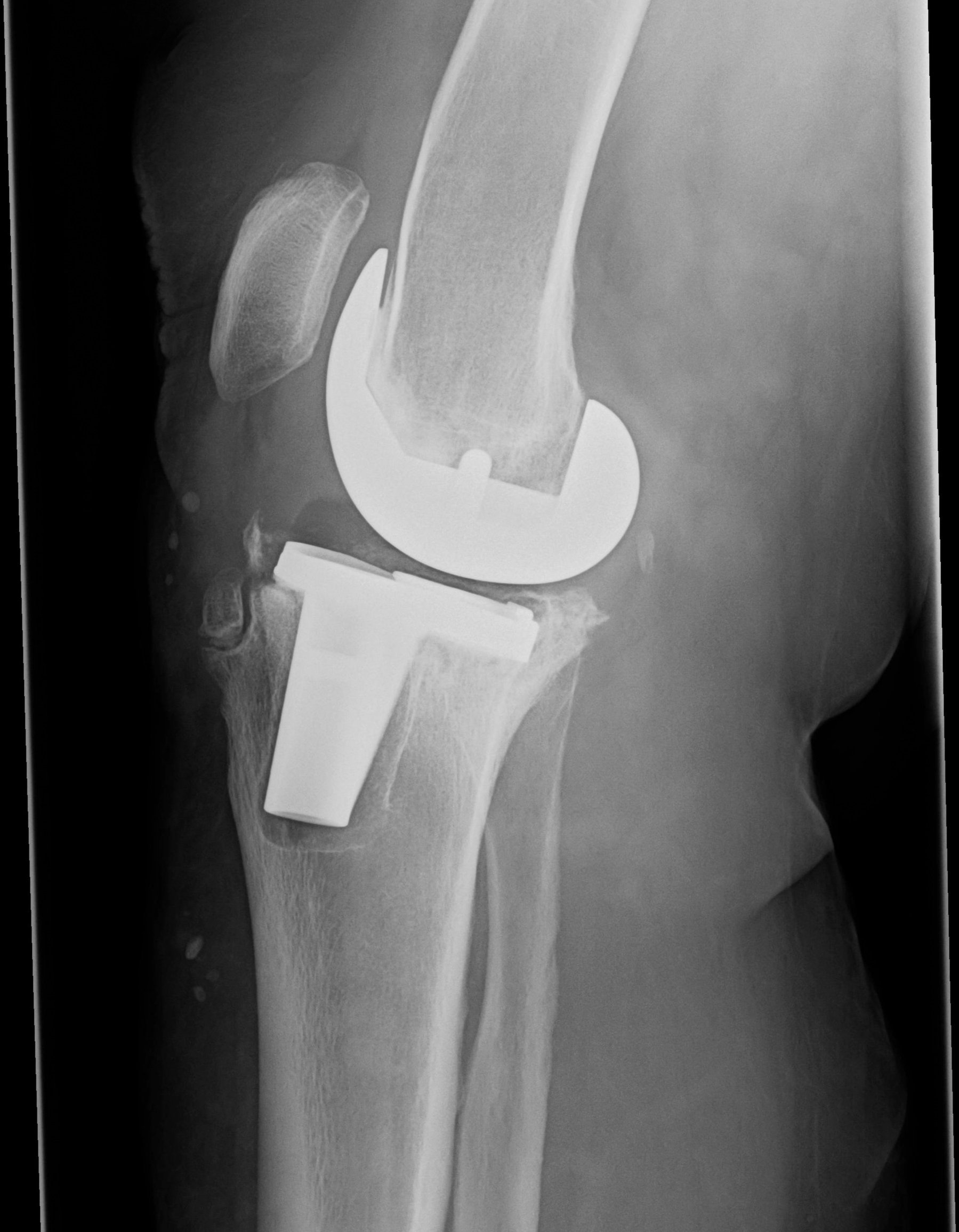 Revision Replacement