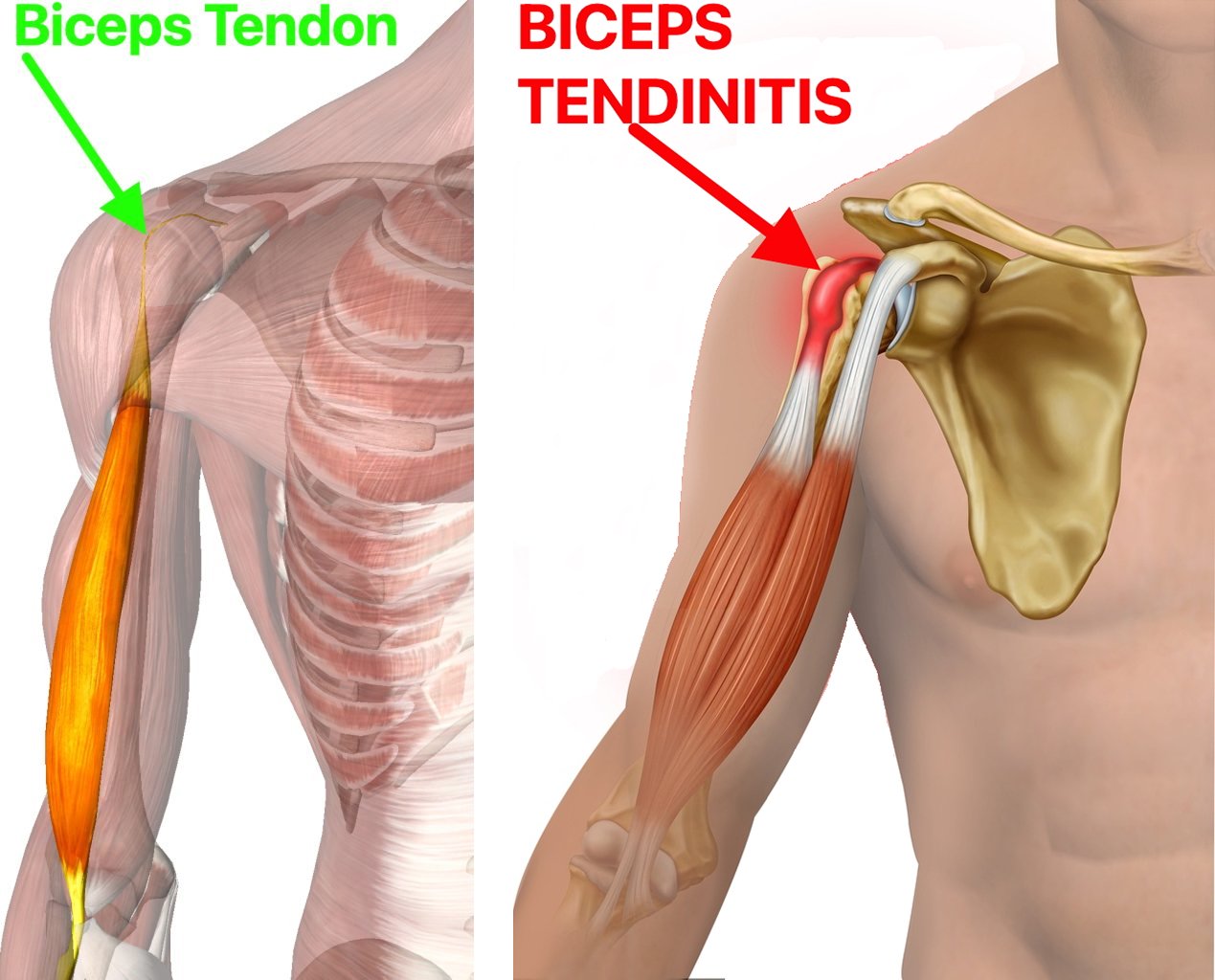 Biceps_Tendinitis.jpeg