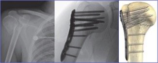 Fixable_Fractures_1.jpeg