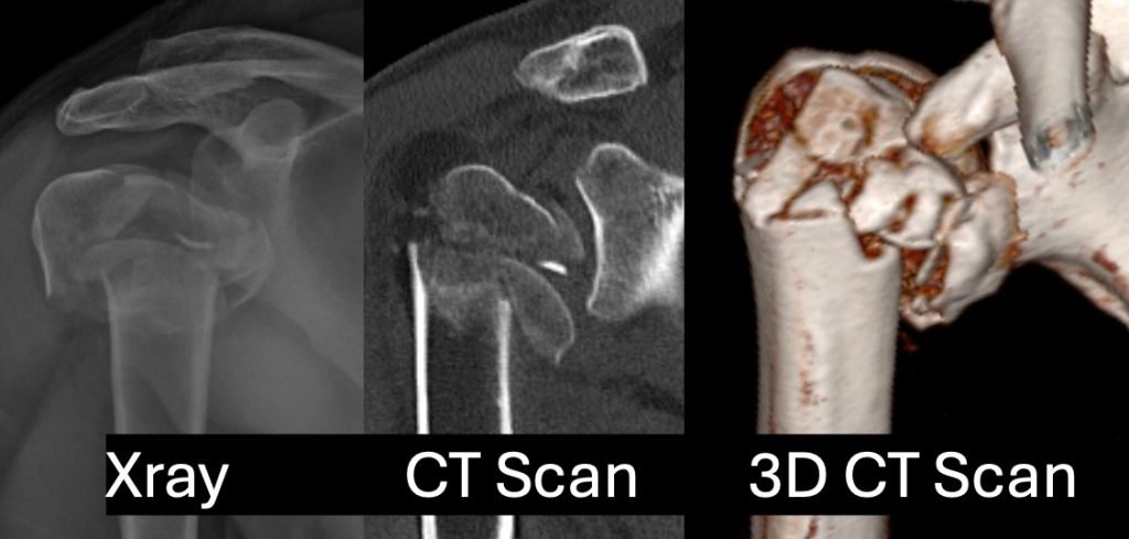 Humerus-Fracture-Shoulder-1024x489.jpeg