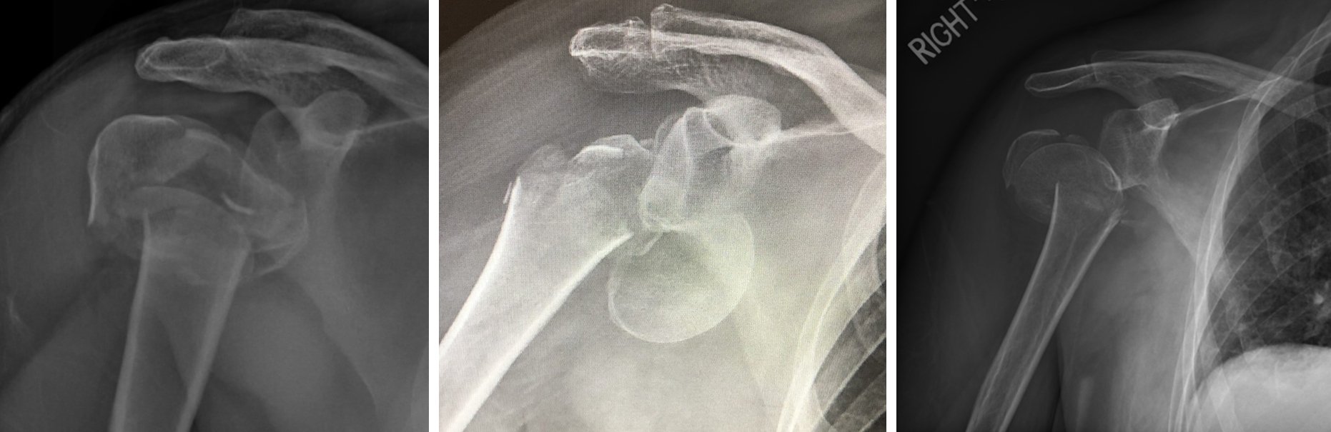 Non-Fixable_Fractures.jpeg