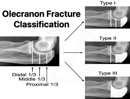 Olecranon-Fracture-Classification.jpeg